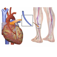 Aortic Valve Replacement Surgery Cost Bangalore | MICS