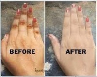 Get Rid Of Vitiligo In Holetown City in Barbados Call +27710732372 Scars And Stretch Marks In Hollandale City in Mississippi